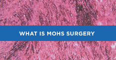 What Is MOHS Surgery